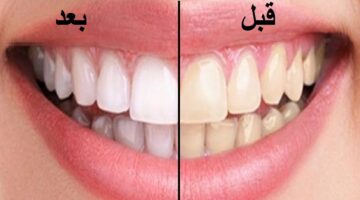 خلطة سحرية لتبييض وتلميع الأسنان