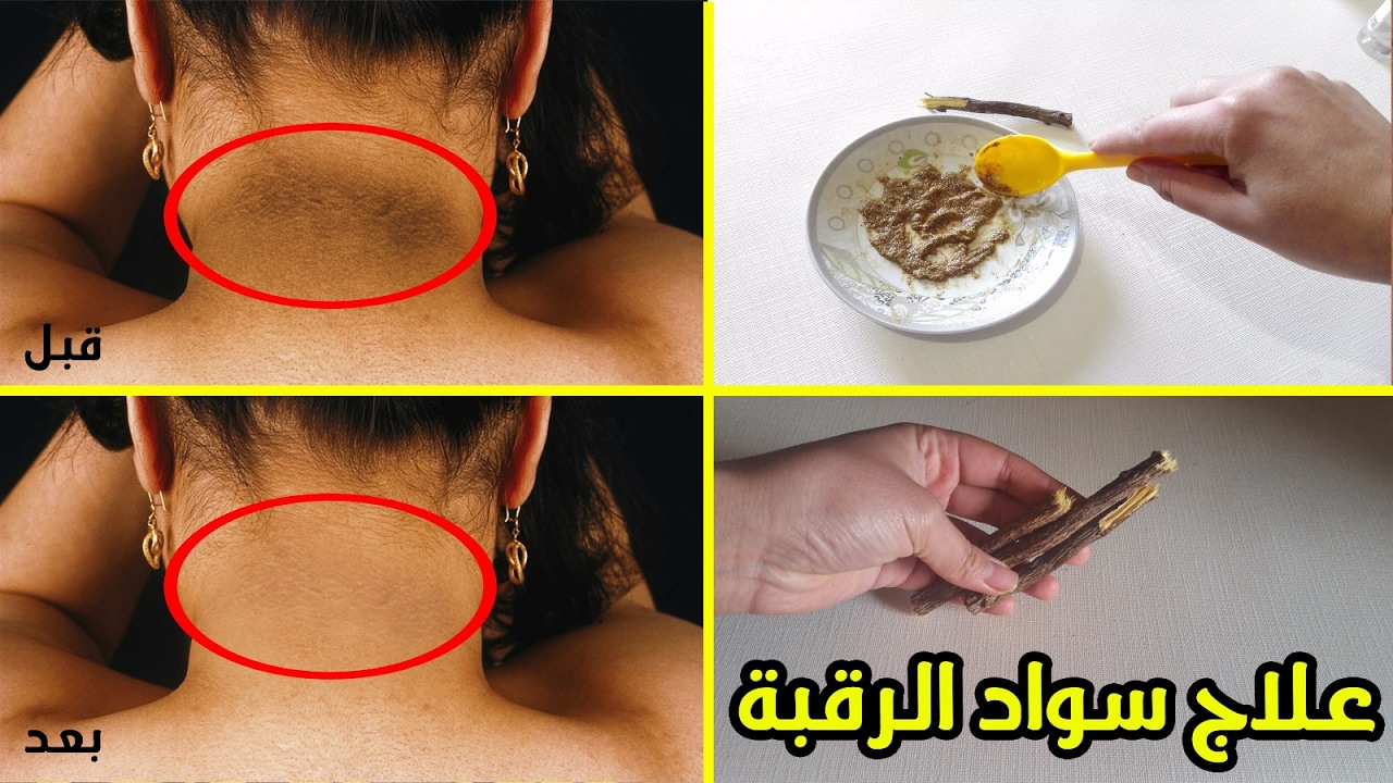 وصفة تبييض الرقبة في ربع ساعة فقط وهتزيلي كل السواد المتراكم
