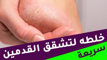وصفة تنعيم القدمين وإزالة الجلد الميت في الكعبين في بيتك