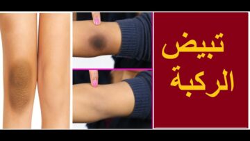 خلطة تبييض الركب والكوعين من الإسمرار وتقشير الجلد الميت نهائياً