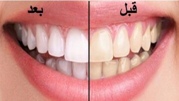 تمتعي بأسنان بيضاء كالثلج بوصفة منزلية لتبييض الأسنان وإزالة الجير والأصفرار بسرعة