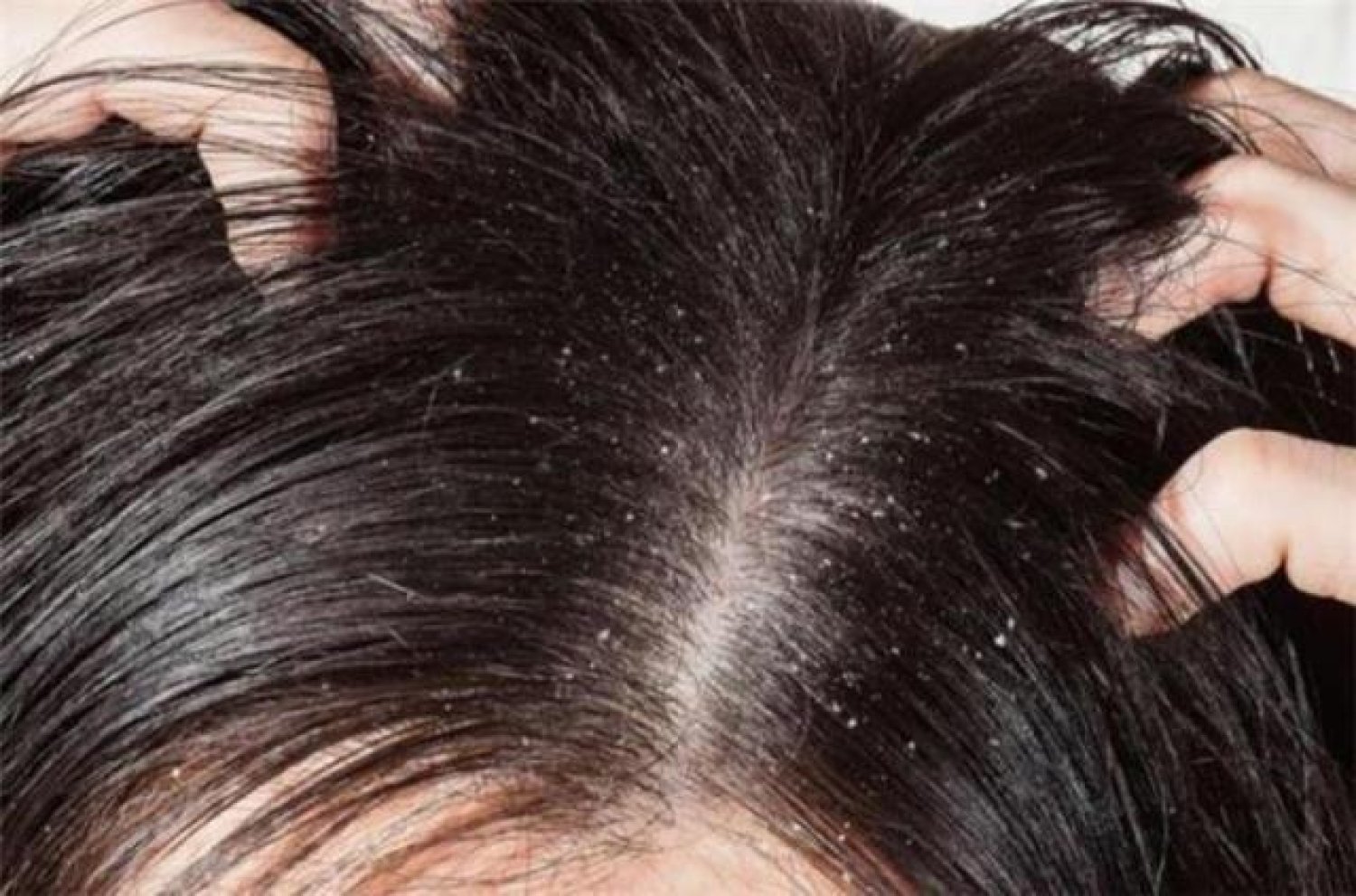 مكون منزلي هيخلصك من قشرة الشعر بشكل نهائي بطريقة مضمونة وفعالة