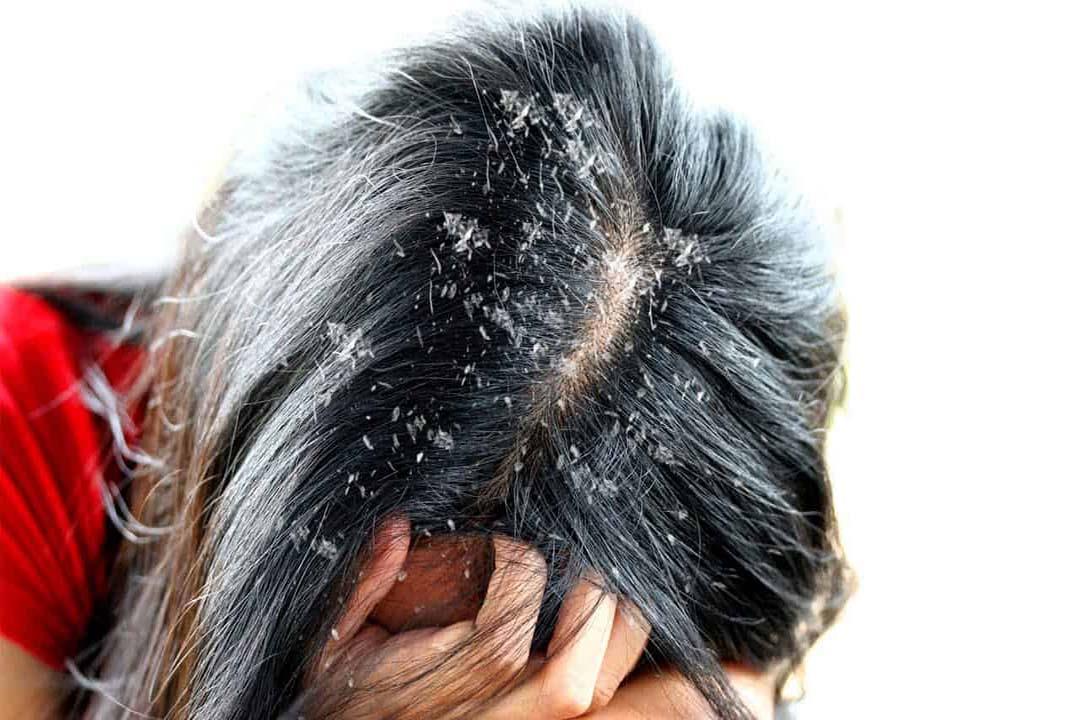 مكون منزلي فعال ومضمون للقضاء على قشرة الشعر نهائياً لن تصدقي النتيجة 5 مكون منزلي فعال ومضمون للقضاء على قشرة الشعر نهائياً لن تصدقي النتيجة