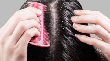 47 190215 tips get rid dandruff 700x400