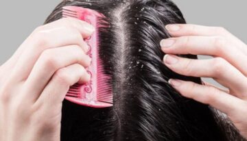 مكون قوي منزلي للتخلص من قشرة الشعر والحكةموجود في المنزل