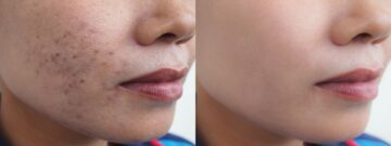 كيف أعالج كلف الحمل طبيعيا ونصائح هامة لتقليل الكلف خلال فترة الحمل أو بعدها
