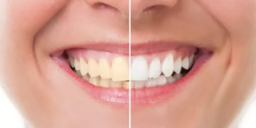 3 وصفات طبيعية جبارة..للحصول على أسنان ناصعة البياض لضحكة أكثر جمالًا