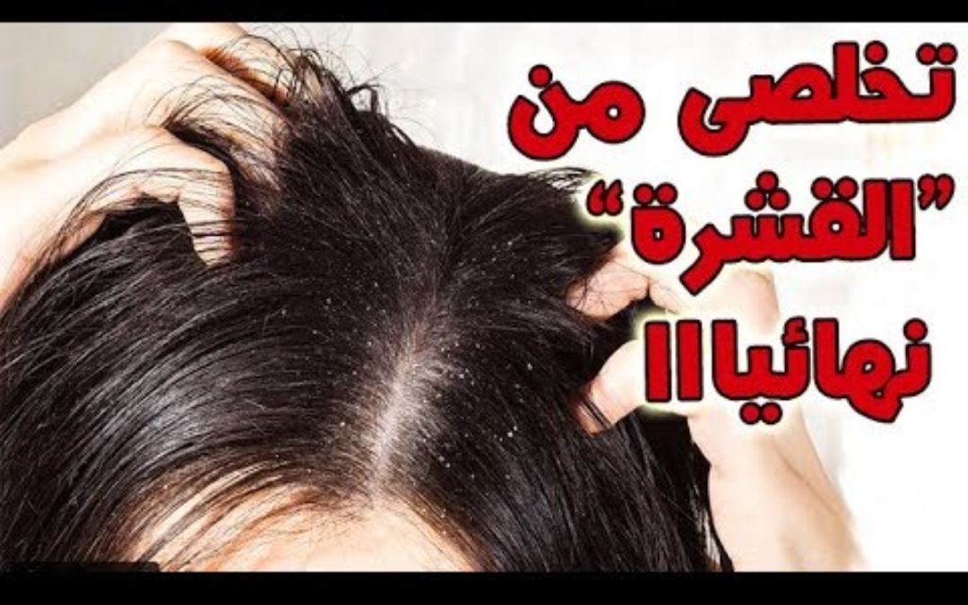 "يابخت اللي جربها"... خلطة سحرية" للقشرة "مش هتلمحي قشرة في شعرك تاني جربيها فورا وودعي الأحراج!! 5 “يابخت اللي جربها”… خلطة سحرية” للقشرة “مش هتلمحي قشرة في شعرك تاني جربيها فورا وودعي الأحراج!!