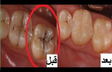 كيفية إزالة التسوس من الأسنان  والجير ؟ وصفات طبيعية فعالة وأمنة تمامًا