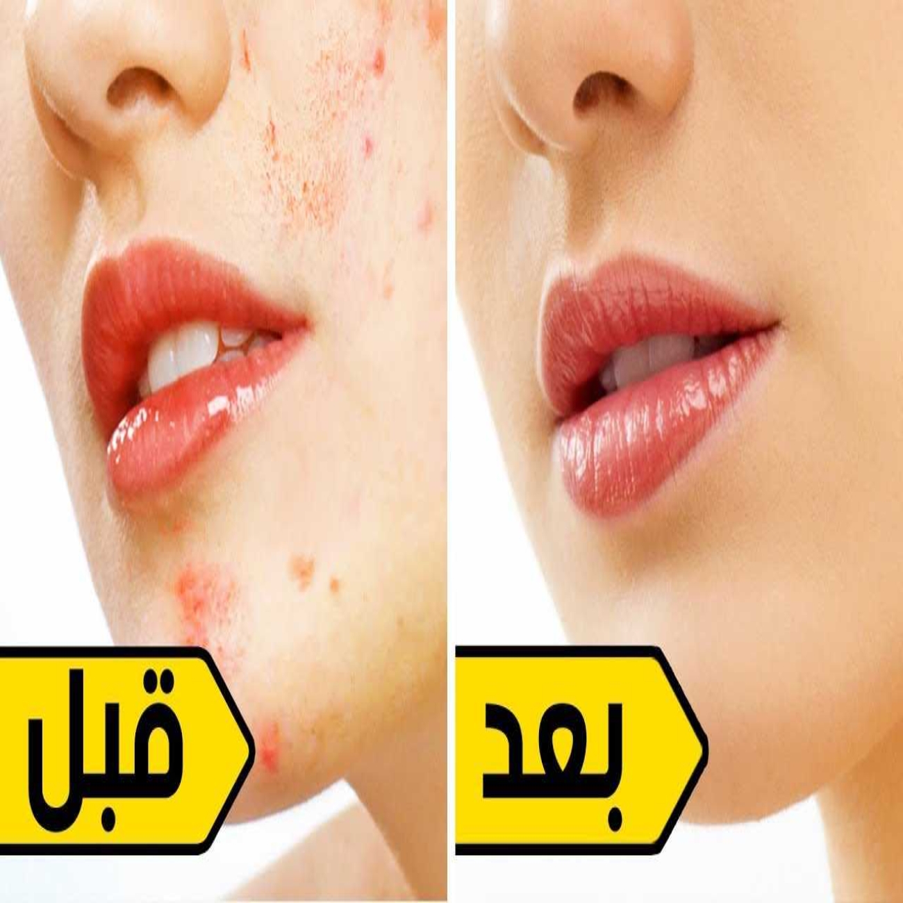 وصفة معجزة للتخلص من حبوب البشرة.. واثارها المزعجة في 7 ايام فقط
