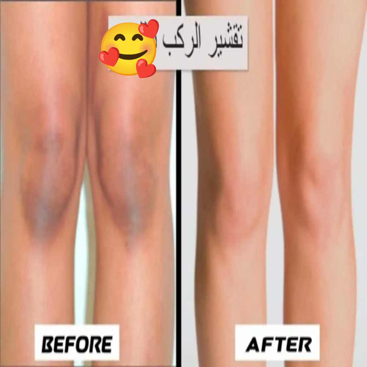 وصفة مفيدة لتقشير وتبييض الركب والأكواع بسرعة.. مش هتصدقي النتيجة