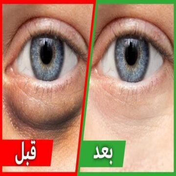 كيف ازيل الهالات السوداء في اسرع وقت؟ 2 وصفة تمت تجربتها آمنه للتخلص من الهالات