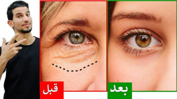 أسهل الطرق للتخلص من تجاعيد الوجه طبيعياً.. نتيجة مبهرة من أول استعمال خلال 7 أيام فقط