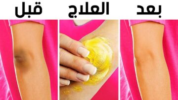 بخلطتي العبقرية تبييض الركب والاكواع وازالة سواد وتصبغات السنين بطريقه سحريه وطبيعيه
