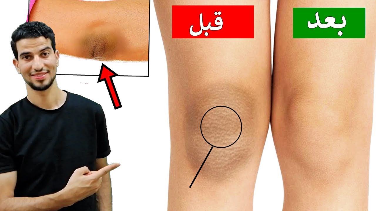 اقوي وصفة لتبييض وتنعيم الكوع والكعبين من الخشونة والسواد بوصفات طبيعية أمنة 3 اقوي وصفة لتبييض وتنعيم الكوع والكعبين من الخشونة والسواد بوصفات طبيعية أمنة