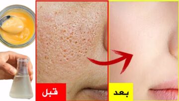 قناع ماء الورد والنشا للحصول على بشرة ناعمة وخالية من المسامات الواسعة