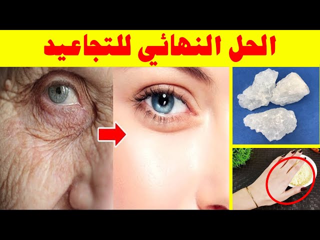 هتخليكي عروسه! وصفه التخلص من التجاعيد وشد البشرة بطريقة طبيعيه هتزيل ترهلات السنين 5 هتخليكي عروسه! وصفه التخلص من التجاعيد وشد البشرة بطريقة طبيعيه هتزيل ترهلات السنين