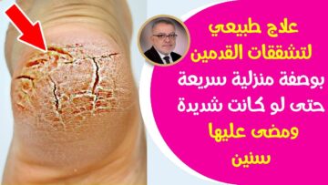 علاج تشقق القدمين نهائيًا بأفضل الوصفات المجربة