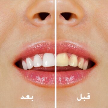 وداعًا للتسوس والاصفرار..أفضل الوصفات المنزلية لتبيض الأسنان بشكل طبيعي