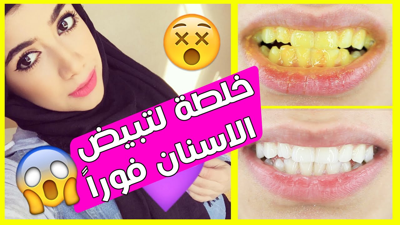 تبييض الأسنان في 5 دقائق بمواد طبيعية … أسنانك لؤلؤ من أول مرة
