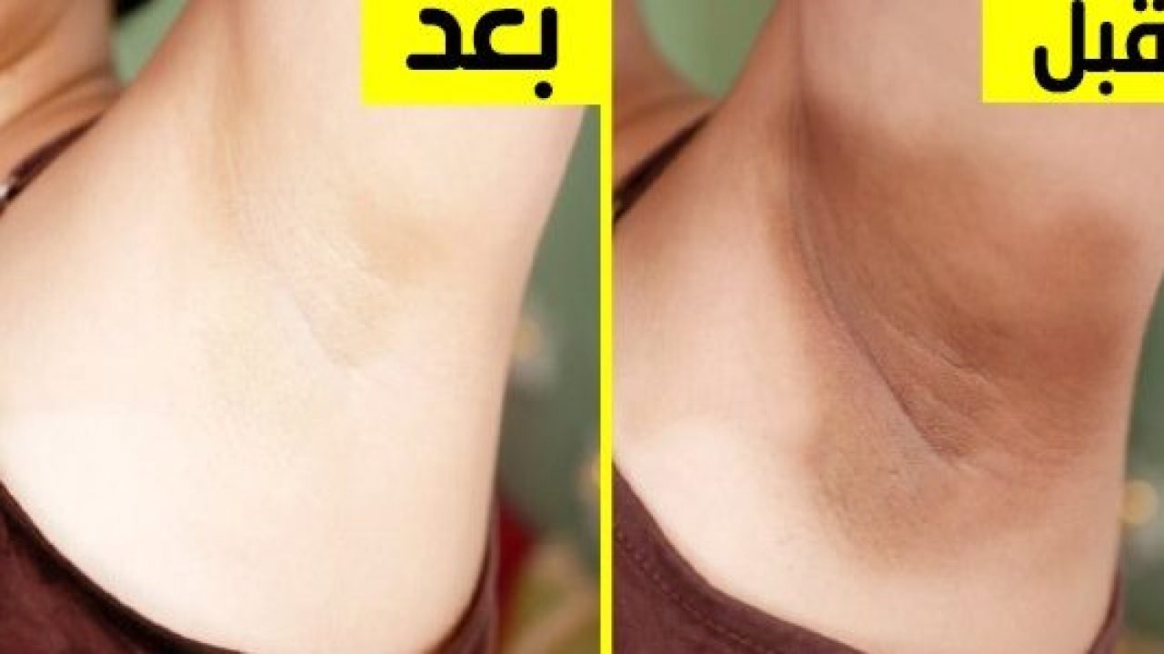 بشرة ناعمة ونضرة للمناطق الحساسة.. وداعًا للاسمرار والالتهابات مع هذه الطريقة البسيطة
