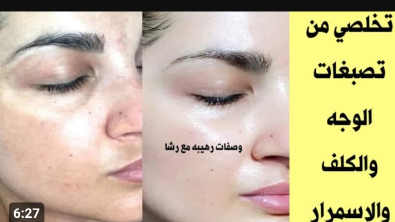 « هتبقى برنسيسة الجيل من النهارده » .. وصفات متقوليش لعدوك عليها هتخلي بشرتك بتلمع وإزالة البقع و التصبغات من الوجه نهائياً 2 « هتبقى برنسيسة الجيل من النهارده » .. وصفات متقوليش لعدوك عليها هتخلي بشرتك بتلمع وإزالة البقع و التصبغات من الوجه نهائياً