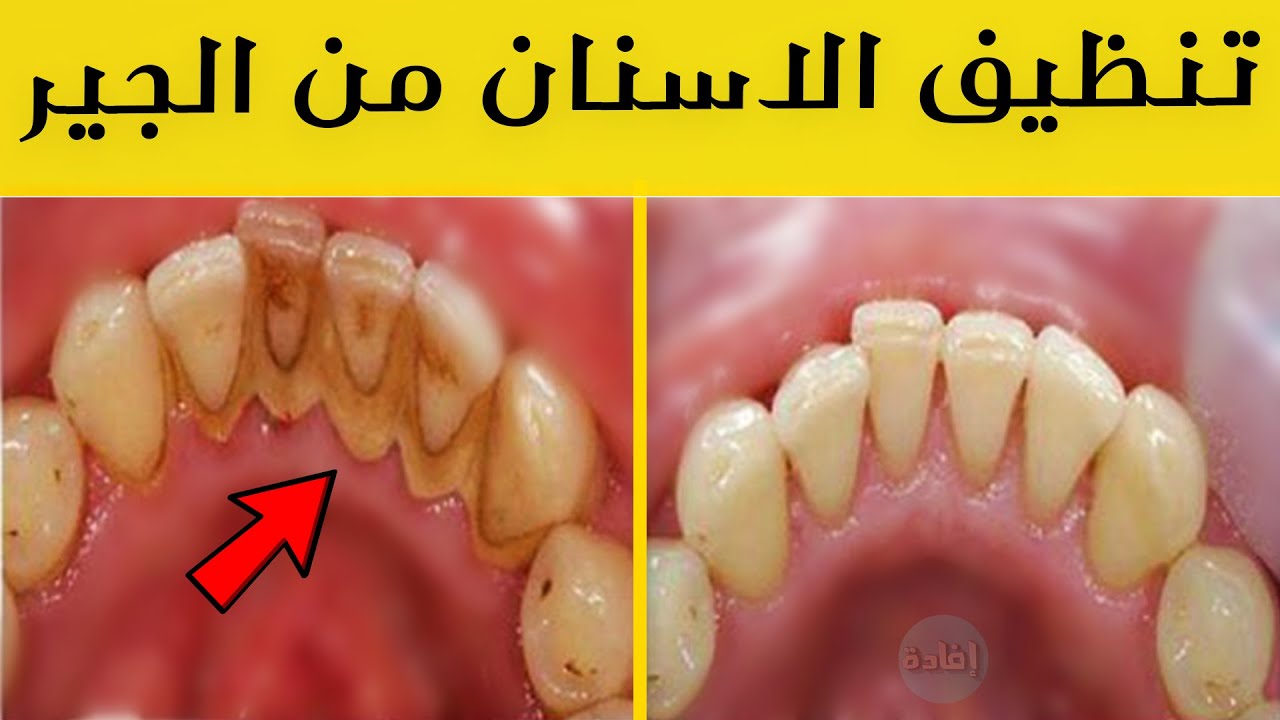 طريقة جبارة لتبيض الأسنان في المنزل في 5 دقائق ستصبح كالثلج ولا حاجه لزيارة الدكتور