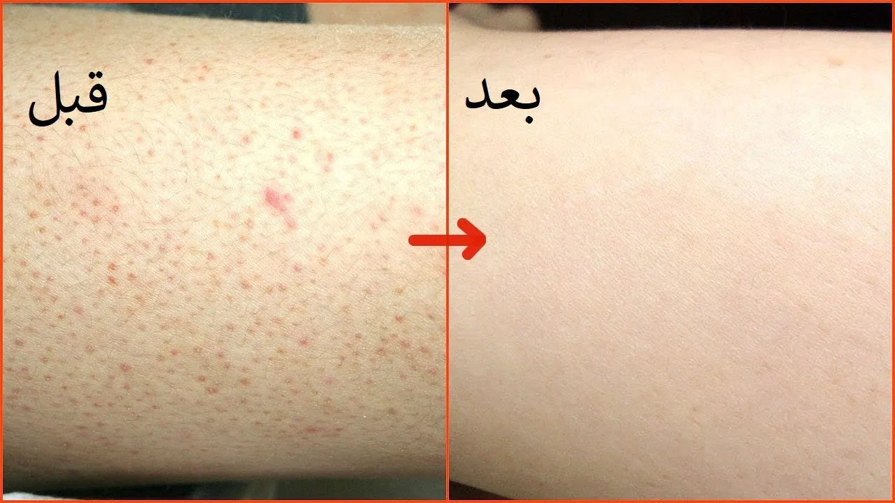 3 خلطات طبيعية تخلصك من مشكلة جلد الوزة في أسرع وقت