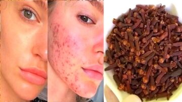 ولا يخطر على بال العفريت.. مغلي القرنفل لحب الشباب نتيجته سحر في الوجه هيخلصك منه