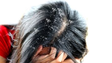 طريقة لإزالة القشرة من الشعر نهائيا