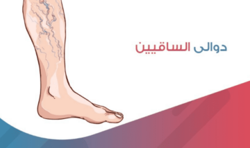 أسباب ظهور الدوالي وأفضل طرق للعلاج منها في وصفات طبيعية من المنزل وبدون تدخل جراحي