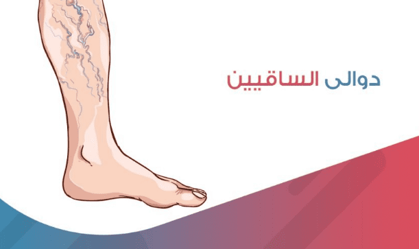 أسباب ظهور الدوالي وأفضل طرق للعلاج منها في وصفات طبيعية من المنزل وبدون تدخل جراحي 5 أسباب ظهور الدوالي وأفضل طرق للعلاج منها في وصفات طبيعية من المنزل وبدون تدخل جراحي