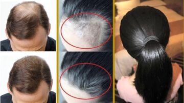 طريقة علاج فراغات الشعر ومقدمة الرأس بسرعة بمكونات من منزلك