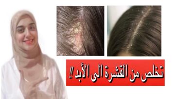 علاج قشرة الشعر نهائيًا .. وداعًا للاحراج ومرحبا بشعر صحي وجميل
