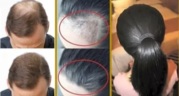 هيخليكي ملكة جمال.. منتج من الصيدلية نتيجته سحر في التخلص من تساقط الشعر وتقصفه