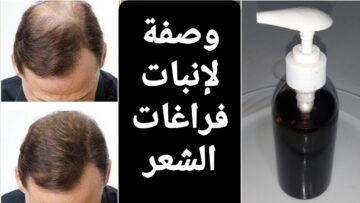 وصفة طبيعية لإنبات فراغات الشعر هتملى كل الفراغات في رأسك وهترجعي بشعر ثقيل من تاني