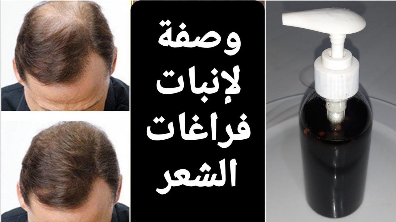 وصفة طبيعية لإنبات فراغات الشعر هتملى كل الفراغات في رأسك وهترجعي بشعر ثقيل من تاني 5 وصفة طبيعية لإنبات فراغات الشعر هتملى كل الفراغات في رأسك وهترجعي بشعر ثقيل من تاني
