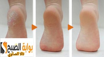 خلطة سحرية قوية للقضاء على تشققات القدمين قولي وداعا لصالونات التجميل