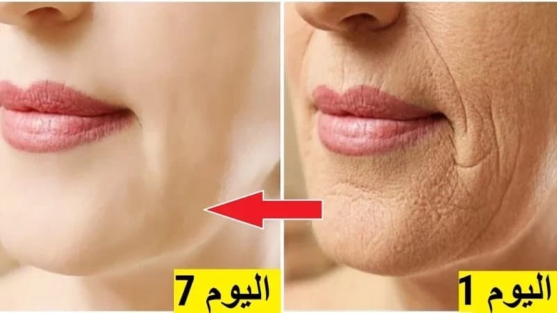 هتبقي قمر 14.. اقوي بوتوكس لنفخ وتسمين الخدود وتوريدها وإزالة التجاعيد والبقع المتراكمه في دقائق هتبقي قشطة 5 هتبقي قمر 14.. اقوي بوتوكس لنفخ وتسمين الخدود وتوريدها وإزالة التجاعيد والبقع المتراكمه في دقائق هتبقي قشطة