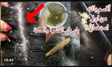 شعرك هيبقى نظيف جدا من الآن .. وصفات مجربة للتخلص من قشرة الشعر من البيت بدون الذهاب إلى الدكتور