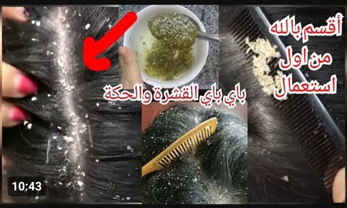 شعرك هيبقى نظيف جدا من الآن .. وصفات مجربة للتخلص من قشرة الشعر من البيت بدون الذهاب إلى الدكتور 5 شعرك هيبقى نظيف جدا من الآن .. وصفات مجربة للتخلص من قشرة الشعر من البيت بدون الذهاب إلى الدكتور
