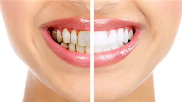 وداعاً للخجل.. وصفات طبيعية لتبييض الاسنان والتخلص من رائحة الفم الكريهة بالمنزل دون أي كيمياويات 5 وداعاً للخجل.. وصفات طبيعية لتبييض الاسنان والتخلص من رائحة الفم الكريهة بالمنزل دون أي كيمياويات