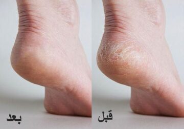 ” للمقبلات على الزواج رجليكي هتنور من حلاوتها” .. الوصفة السحرية لتقشير كعب رجليكي في البيت