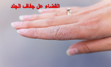 وداعاً للقشف في الشتا.. وصفة طبيعية ستبهرك في القضاء على جفاف الجلد وترطيبه