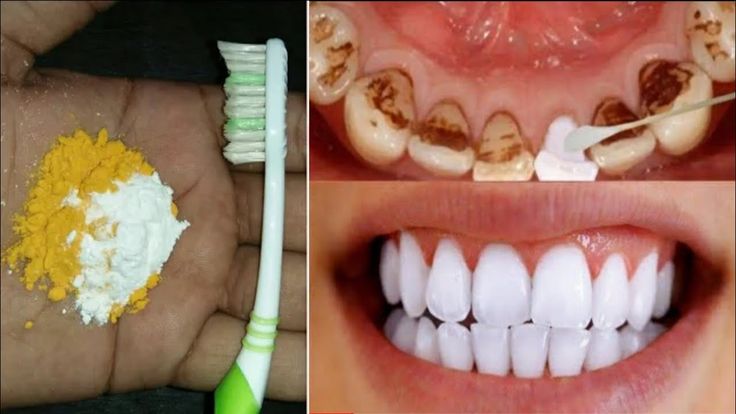 خليهم زي اللؤلؤ أسرع طريقة لتبييض الاسنان في 5 دقائق هتشيل كل أصفرار وسواد السنين بسهولة