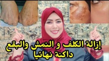 الكل هيسألك عن الطريقة.. مكون سحري لإزالة الكلف في 3 أيام بكل سهولة