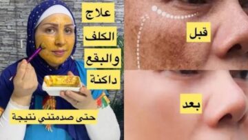 وفري فلوسك.. علاج طبيعي سحري هيخلصك من الكلف بسرعة رهيبة مش هتصدقيها