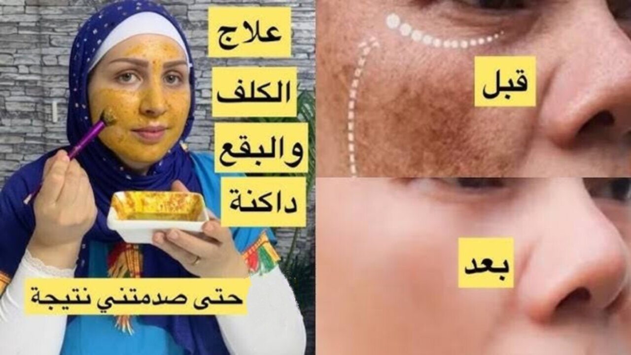 وفري فلوسك.. علاج طبيعي سحري هيخلصك من الكلف بسرعة رهيبة مش هتصدقيها 5 وفري فلوسك.. علاج طبيعي سحري هيخلصك من الكلف بسرعة رهيبة مش هتصدقيها