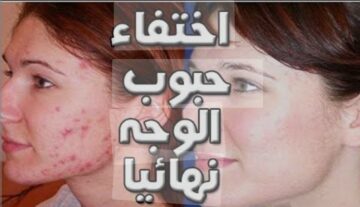 خلطة طبيعية للتخلص من حبوب الوجه نهائيًا