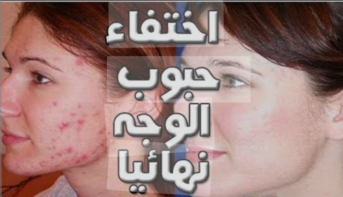 خلطة طبيعية للتخلص من حبوب الوجه نهائيًا 5 خلطة طبيعية للتخلص من حبوب الوجه نهائيًا